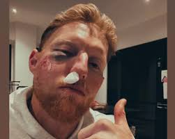 ‘You should see the cricket ball’ jokes Ben Stokes after being struck in the face | Ben Stoke…