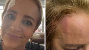 ‘That’s a lot’: Star reveals shocking injury | Carrie Bickmore gives update following ‘crim…